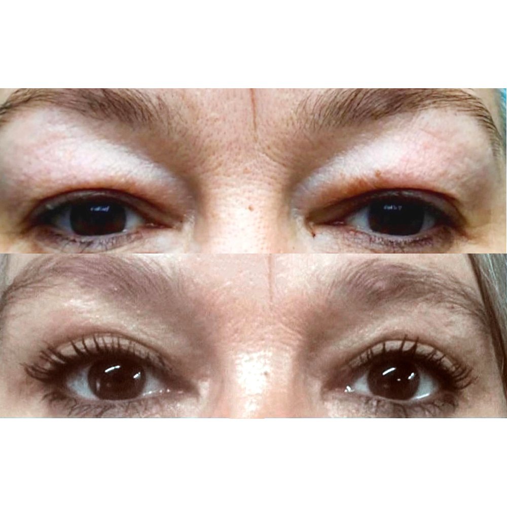 Blepharoplasty