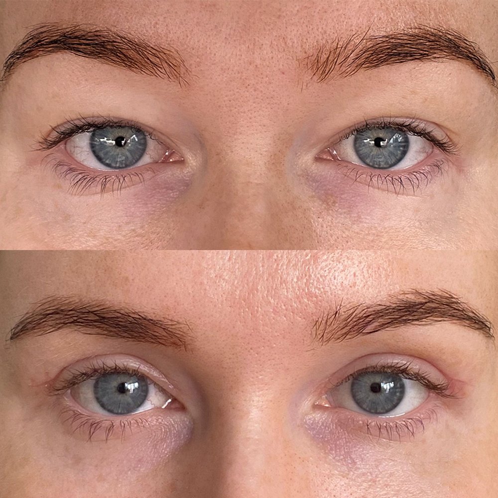 Blepharoplasty-2