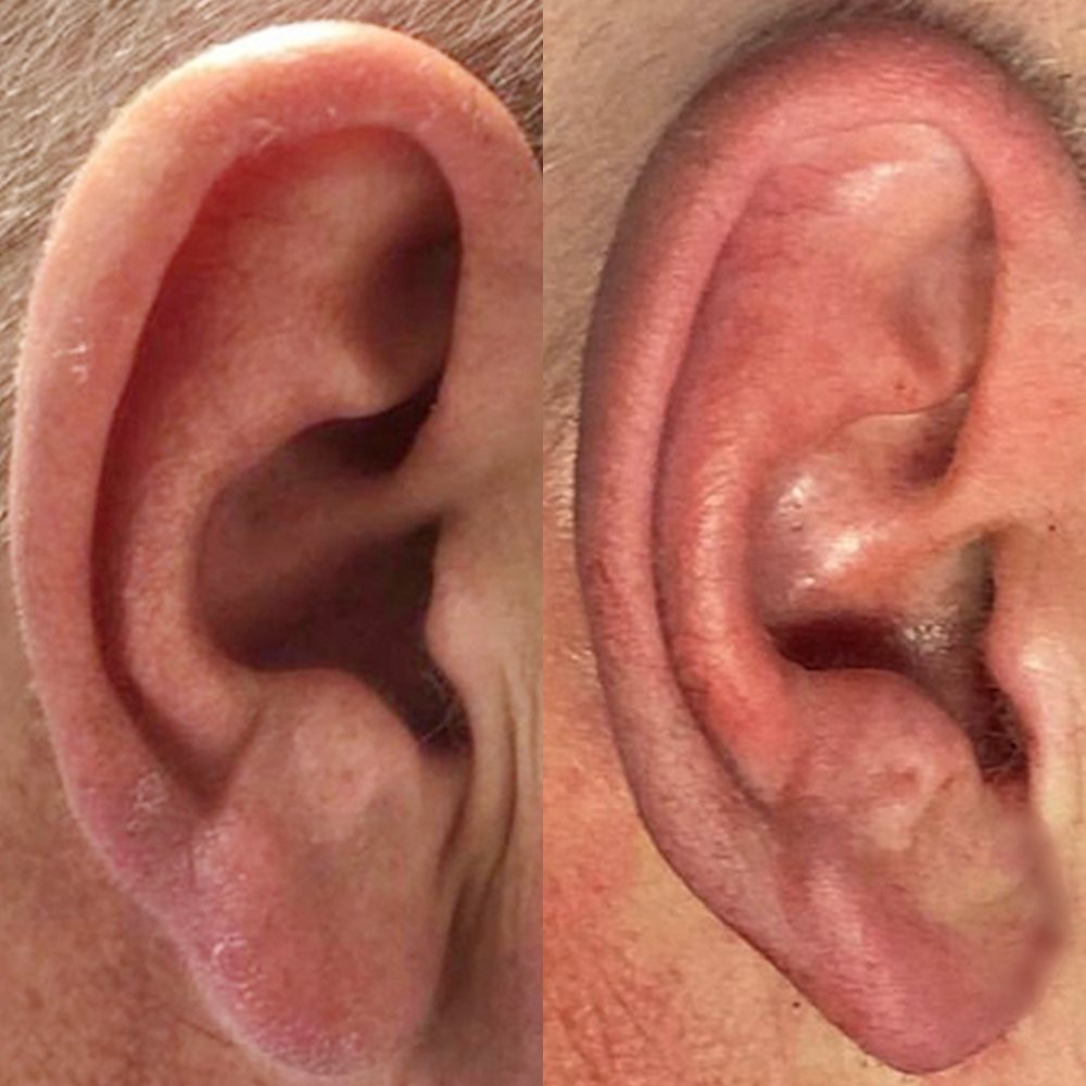 Earlobe-Repair