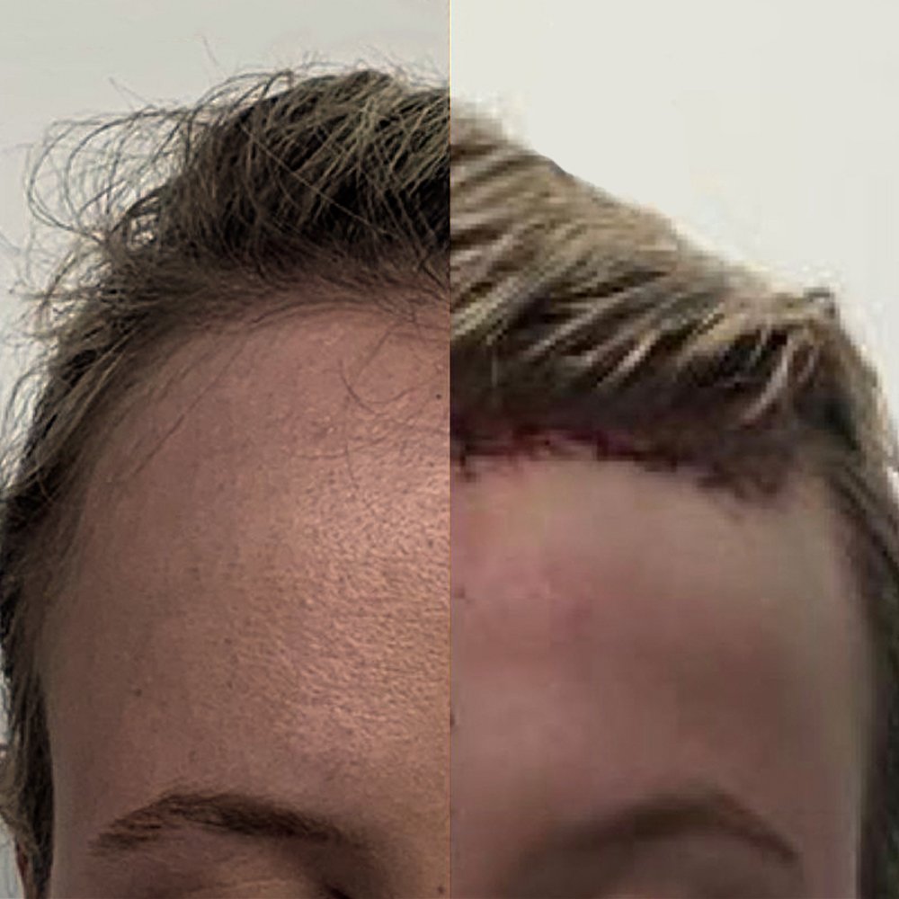 Forehead-Reduction