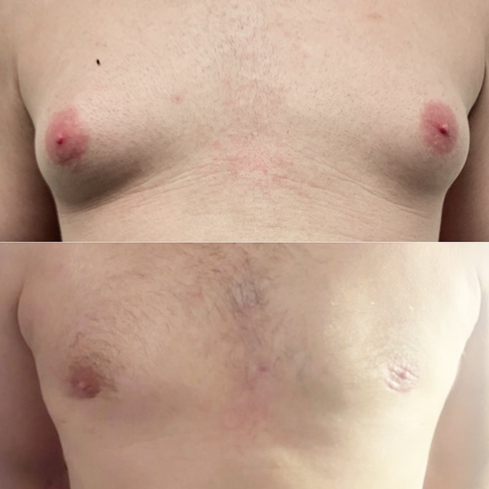 Gynecomastia-2