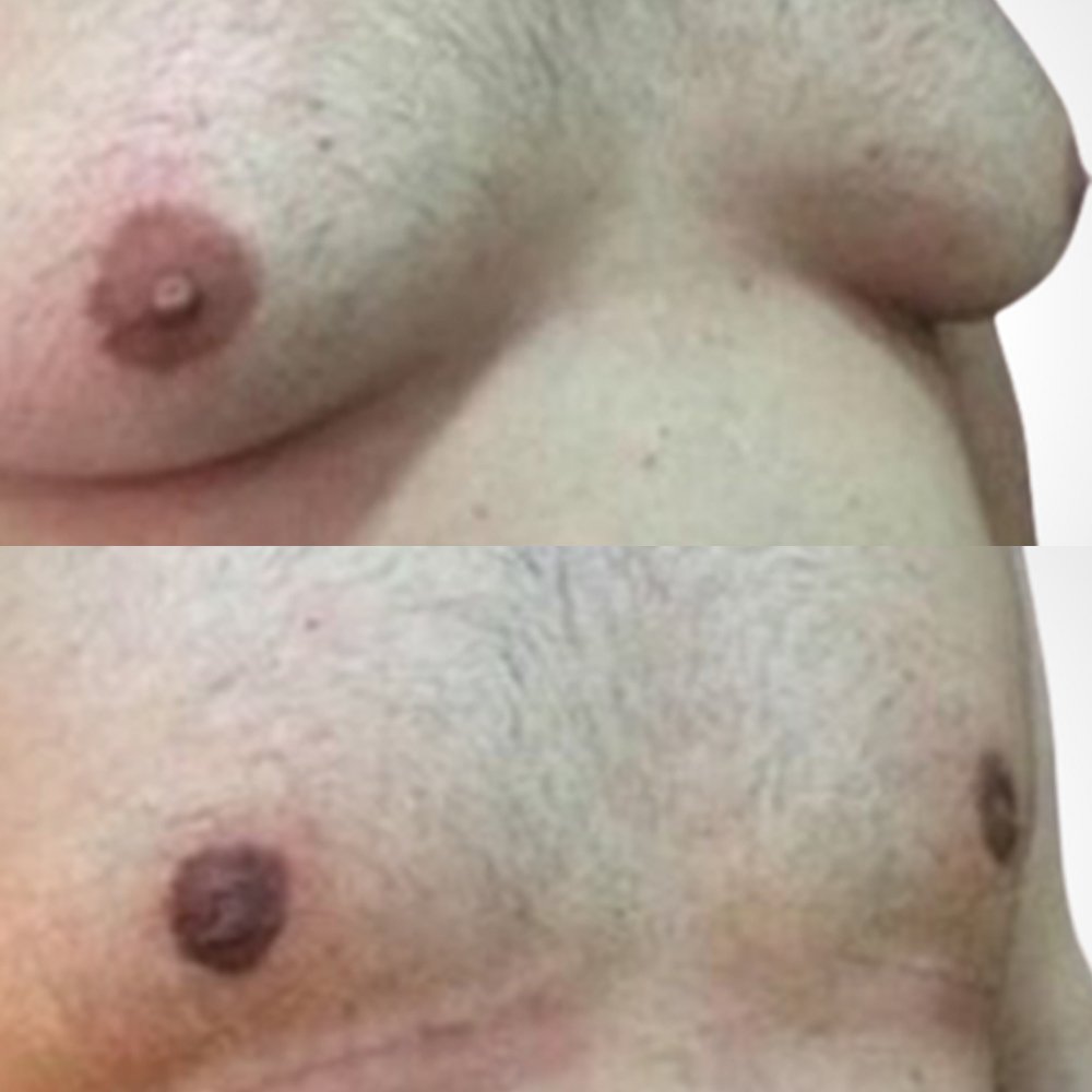 Gynecomastia