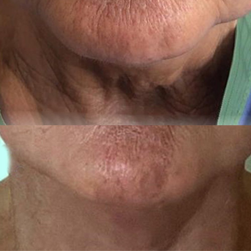 Neck-Lift-2