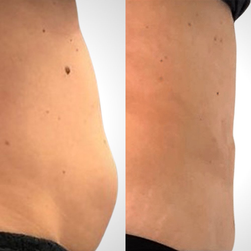 TummyTuck2