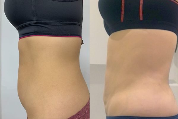 Abdomen Liposuction Abdomen Liposuction