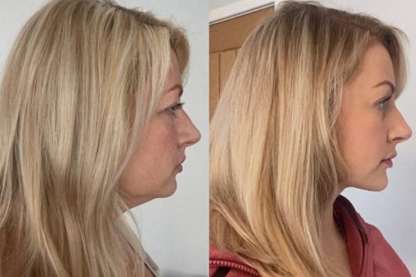 Chin Implant with Liposuction Chin Implant with Liposuction