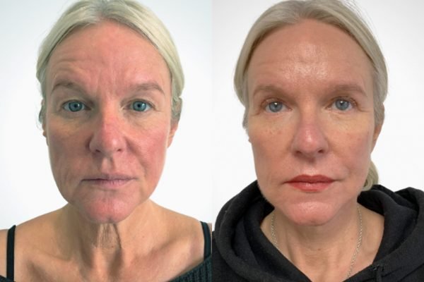 Face & Necklift Face & Necklift