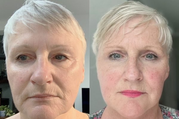 Face & Necklift Face & Necklift