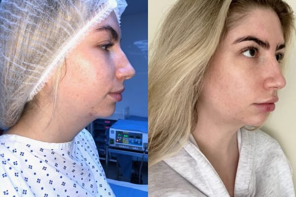 Neck Liposuction Neck Liposuction