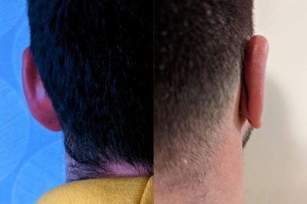 Otoplasty1 Otoplasty1