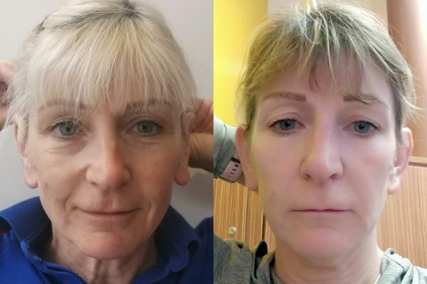 Otoplasty2 Otoplasty2