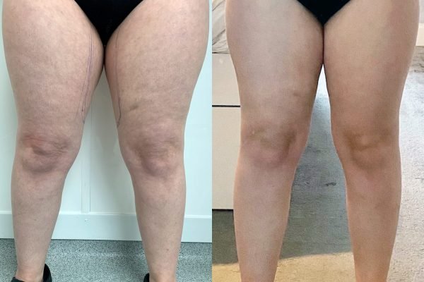 Thigh Liposuction Thigh Liposuction